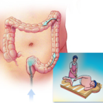 Basti Ayurvedic Enema Treatment for Colon Cleansing