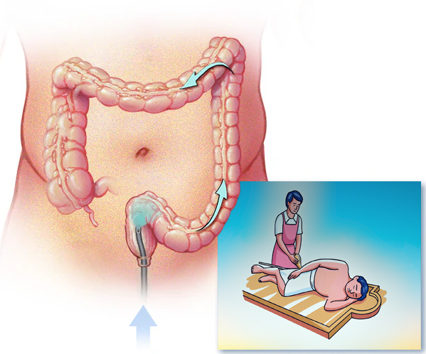 Basti Ayurvedic Enema Treatment for Colon Cleansing